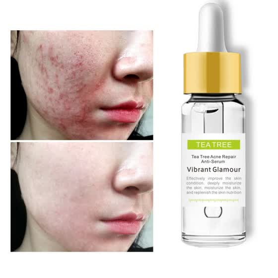 best essence for acne scars